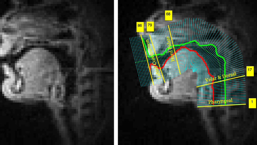 ‘A Means to Speak’: Capturing Acoustic Information Through Real-time MRI